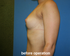 plastic-surgery-breast-augmentation